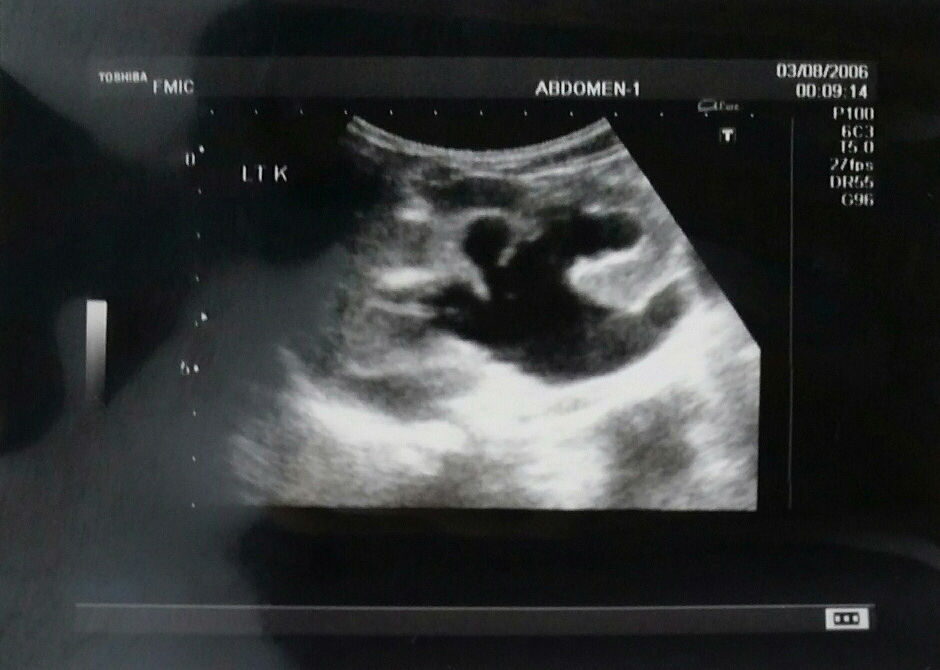 Posterior Urethral Valve